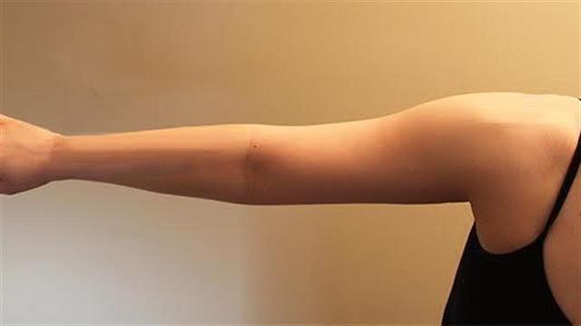 Μικροχειρουργική αντιμετώπιση του λεμφοιδήματος άνω άκρου μετά από μαστεκτομή